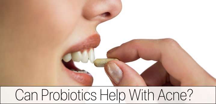 Does Probiotics Help with Acne?