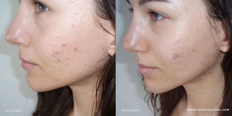 How I Cured My Cystic Acne Update: 1 Year After Probiotics