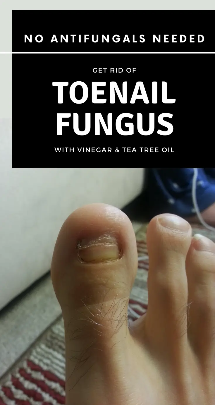 No Antifungals Needed: Get Rid Of Toenail Fungus With ...