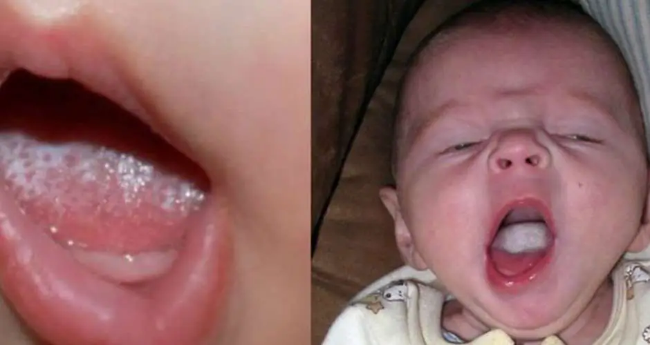 Oral Thrush in Babies : Reasons, Symptoms Home Remedies
