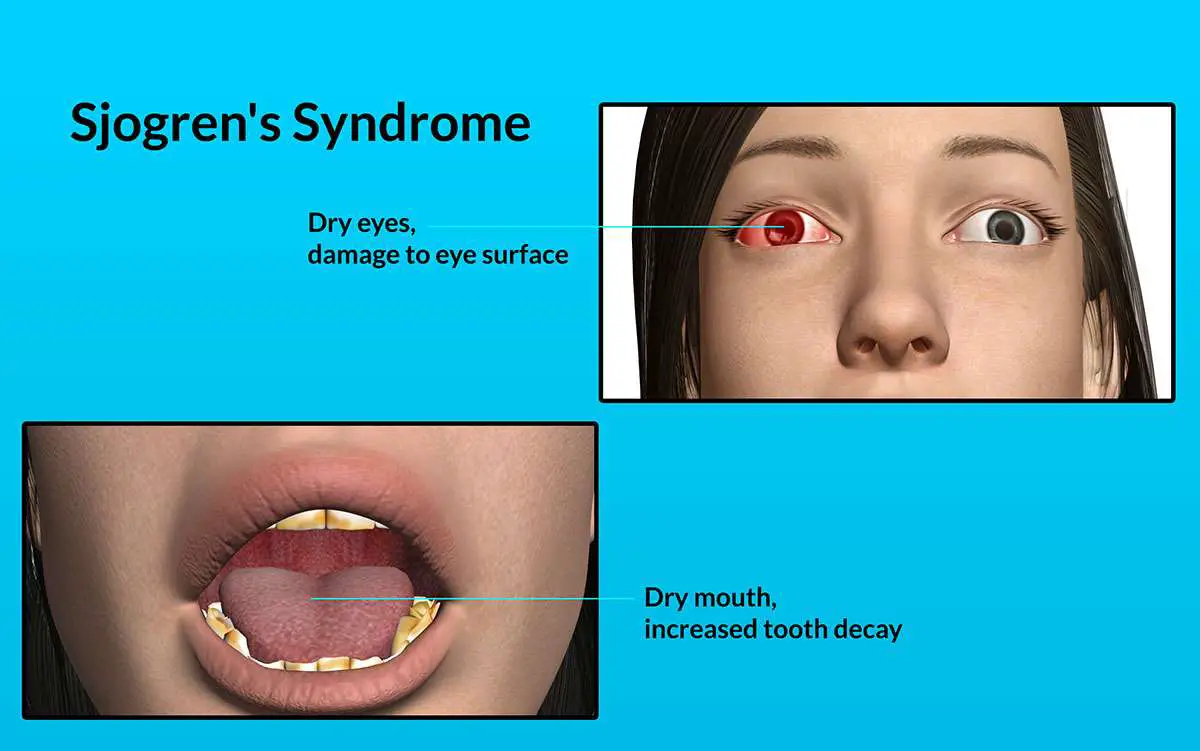 Sjögrens syndrome (dry syndrome) causes symptoms and ...